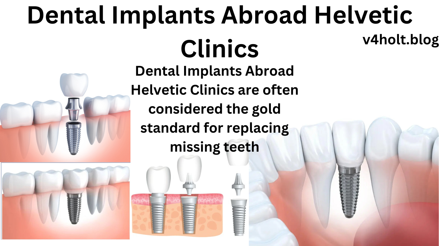 Dental Implants Abroad Helvetic Clinics