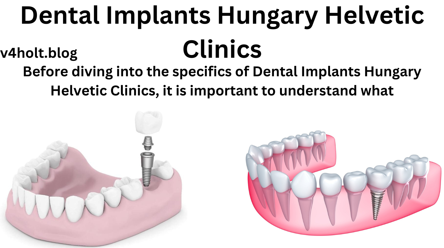 Dental Implants Hungary Helvetic Clinics